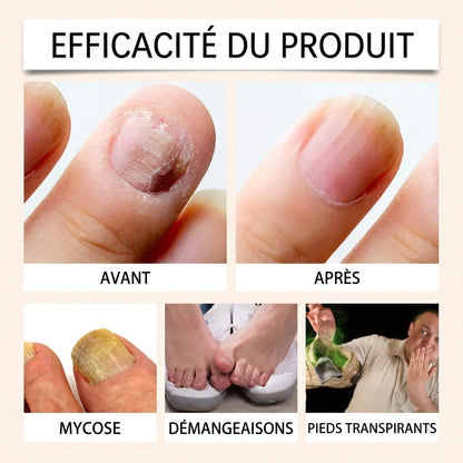 Spray pour les ongles au venin d'abeille – soin efficace pour vos ongles