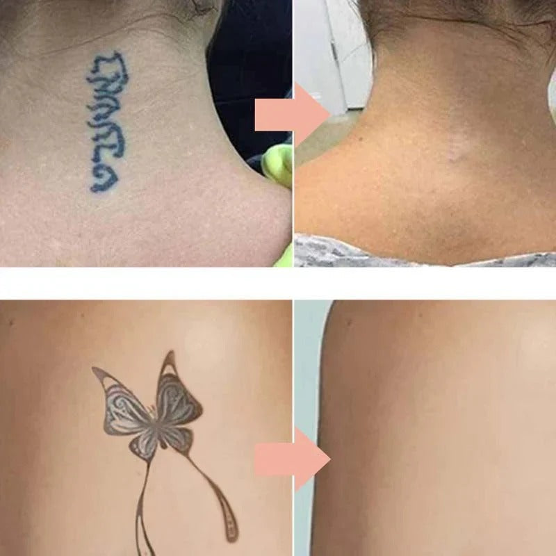 Crème efficace pour atténuer les tatouages – Formule douce et sûre